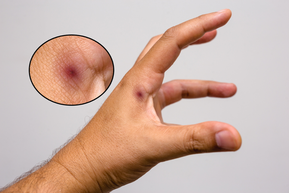 A close-up of a hand with a round, dark, swollen lesion on the knuckle—possibly from poisonous scorpions. An inset shows a magnified view of the lesion, highlighting its red and purple coloration and emphasizing potential risks.