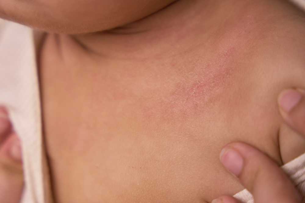 A close-up of a child's upper chest and neck shows a patch of red, irritated skin, highlighting potential health risks as someone gently pulls down the shirt collar to reveal the affected area.