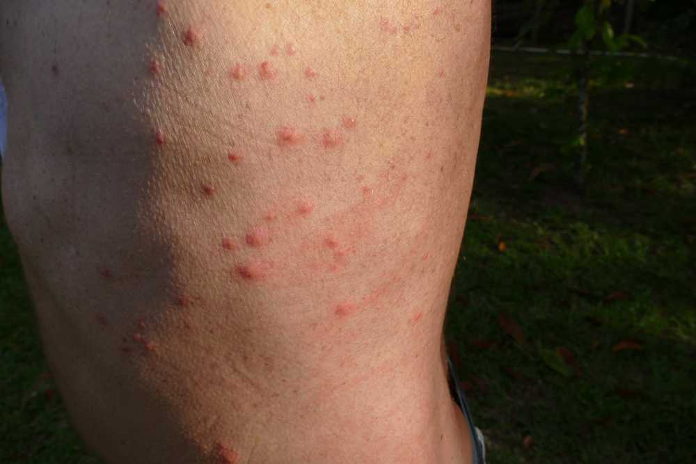 Featured image for Do Bed Bug Bites Hurt? Symptoms, Itch Relief, & Treatment